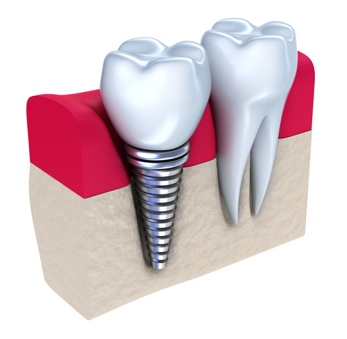 Implantología Dental Implantes Dentales